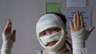 Тяжёлые ожоги от взрыва воздушных шаров получила жительница Алматы